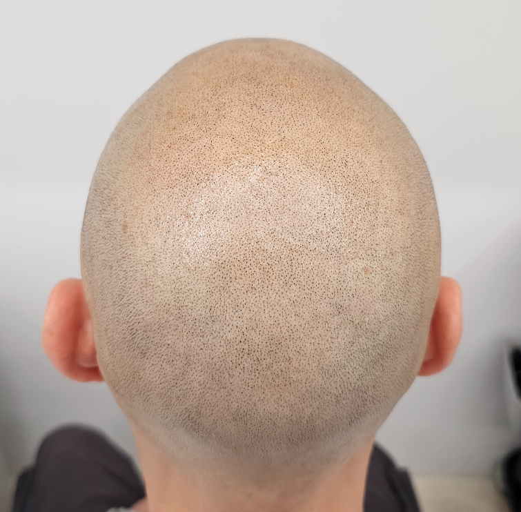 calvitie homme retrait ligne frontale homme perte de cheveux homme chute cheveux héréditaire traitement chute de cheveux homme
